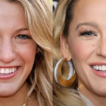 Blake Lively Nasen OP