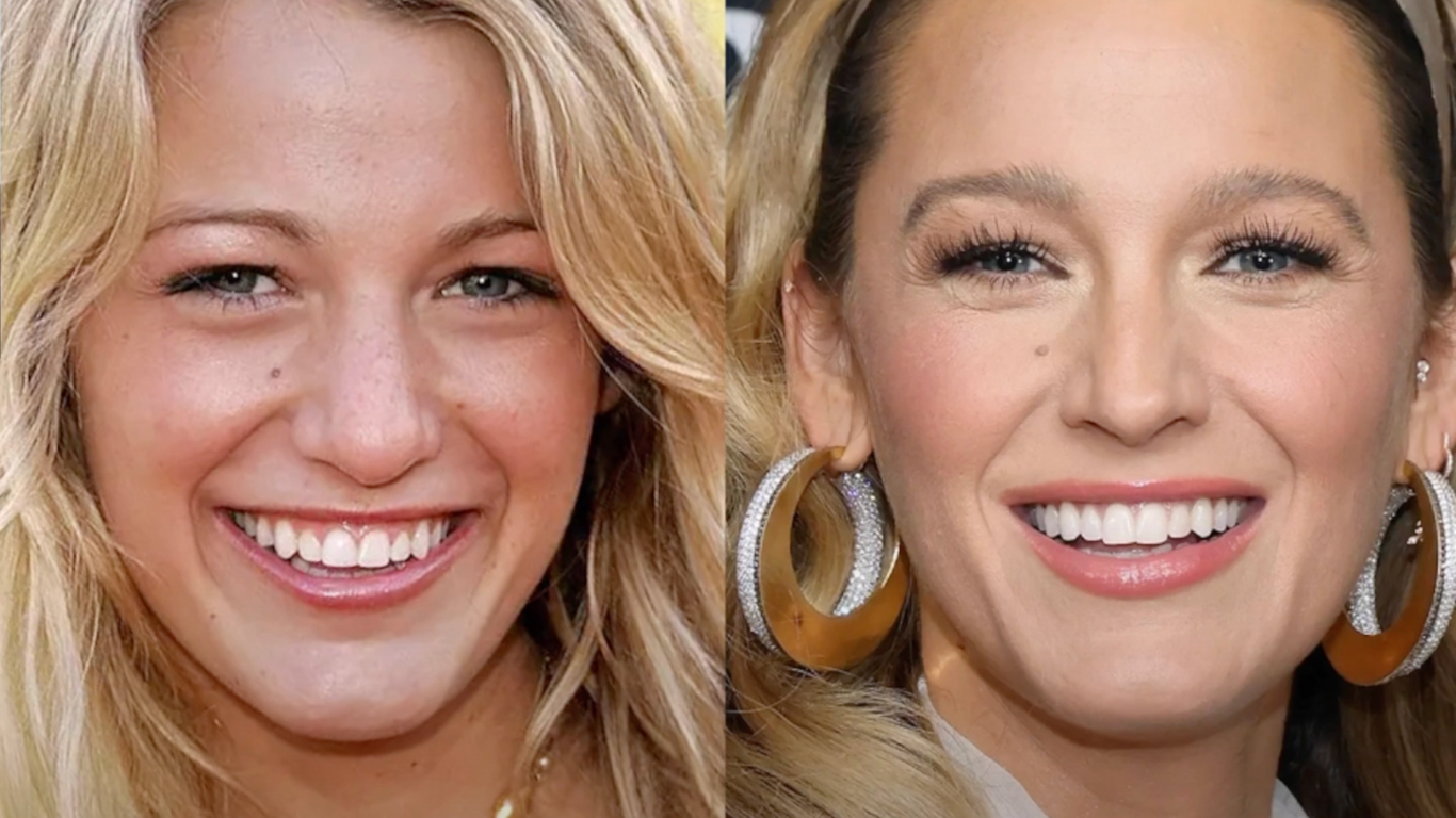 Blake Lively Nasen OP