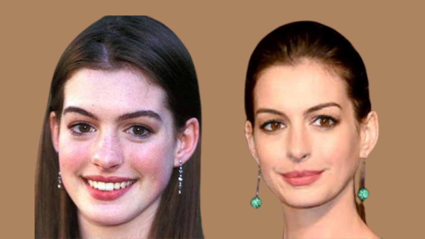 Anne Hathaway Nase vorher nachher Vergleich – subtile Unterschiede im Nasenprofil